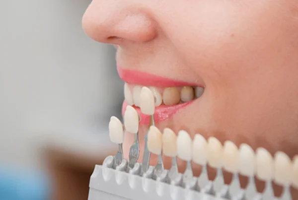 Teeth Whitening