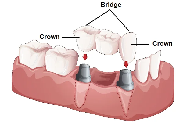Crown and Bridges