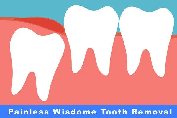 Painless Tooth Extraction