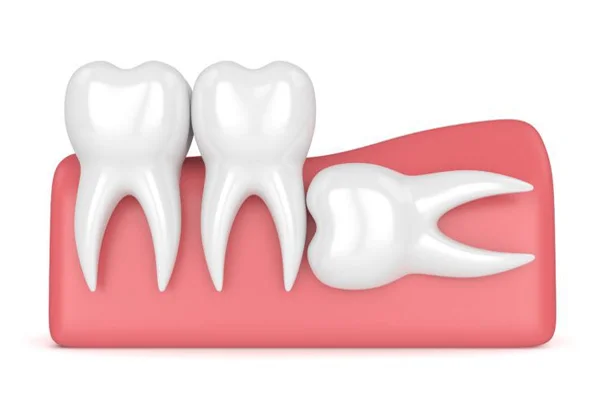 Impaction