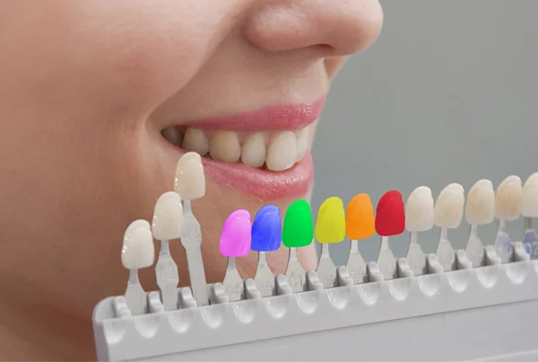 Tooth Coloured Fillings