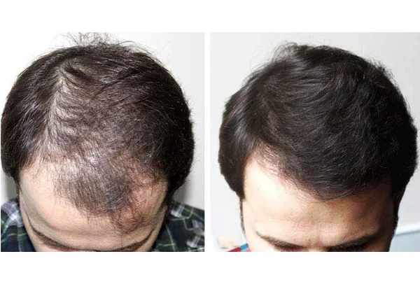 PRP Therapy for Hair
