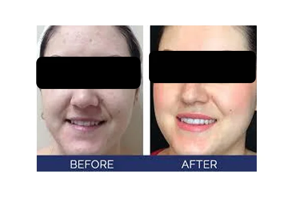 Hydrafacial