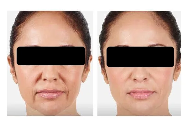 Dermal Fillers
