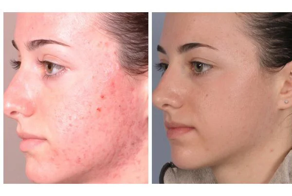 MNRF Treatment