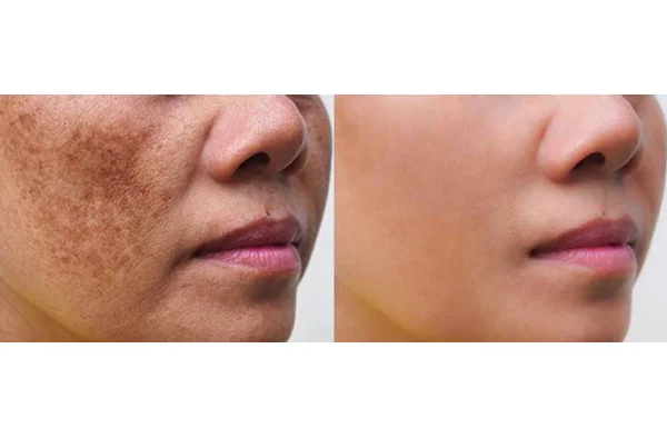 Melasma