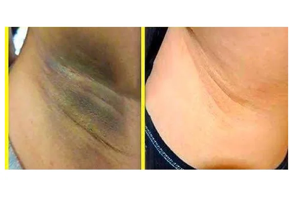 Depigmentation Treatment