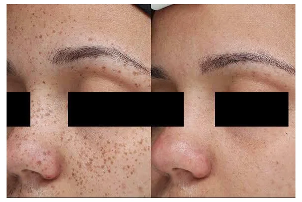 Freckles Treatment