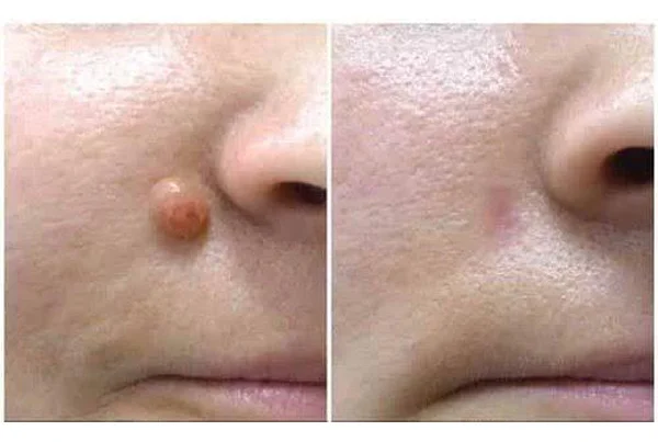 Moles Removal Treatement
