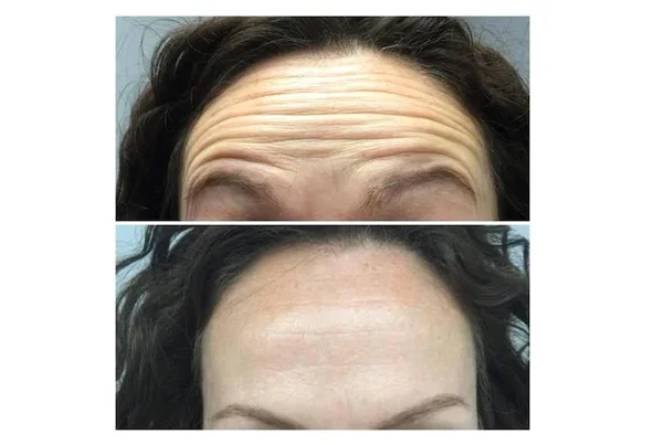 Wrinkles Treatment