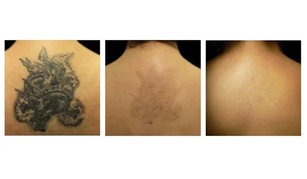 Tattoo Removal or Making