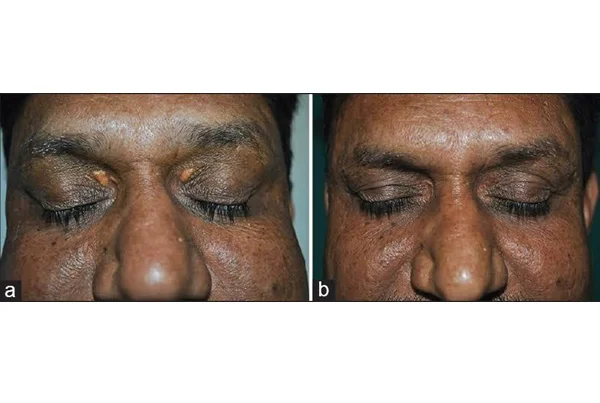 Xanthelasma Palpebrarum Treatment