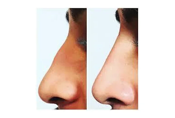 Liquid Rhinoplasty Treatment