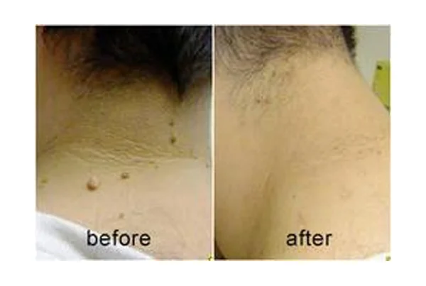 Skin Tag Removal
