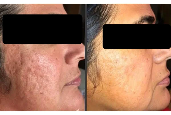 Scar Treatment
